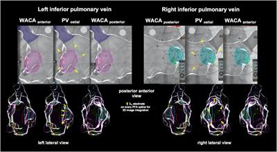 Wide antral circumferential vs. ostial pulmonary vein isolation using pulsed field ablation—the butterfly effect